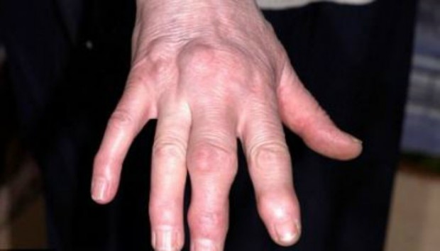 Reaktivni artritis – uzroci, simptomi i liječenje