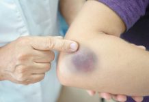 Kako se bolesna jetra pokazuje na koži,nogama? OVO SU SIMPTOMI BOLESNE JETRE…