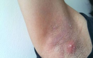 LJUDI SE NE PERU ISPOD PAZUHA KAKO TREBA: Stručnjak za higijenu savetuje čime da izlečite bubuljice i uklonite znoj