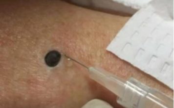 “Zeni je ovo stojalo na ledjima godinama- Kada je doktorica uzela spricu i bocnula svi su zaledjeni ostali.” SNIMAK pregledan 33 miliona puta