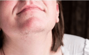 ZNATE LI ZAŠTO SE KOD ŽENA JAVLJAJU DLAČICE NA BRADI? Evo šta vam organizam govori