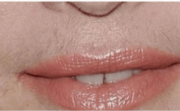 SVAKA ŽENA ZASLUŽUJE DA OVO ZNA: Prirodnim putem uklonite brkove i druge neželjene dlačice sa tijela zauvijek