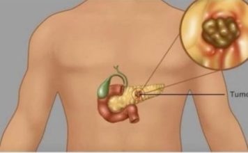 Rak gušterače je tihi ubojica. Stručnjaci podsjećaju da obratite pozornost na pet glavnih simptoma