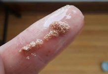 Bele grudvice u jajetu: šta to zaista znači i da li treba da brinete?