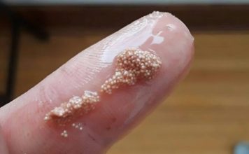 Bele grudvice u jajetu: šta to zaista znači i da li treba da brinete?