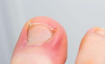 PAZITE SE! Ako nokti pokažu ovaj znak, idite odmah kod ljekara: Upozorenje na PROBLEM koje može biti OZBILJAN