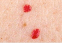 IMATE LI OVE CRVENE TAČKICE NA TIJELU? To nisu popucali kapilari, evo o čemu je zaista riječ