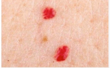 IMATE LI OVE CRVENE TAČKICE NA TIJELU? To nisu popucali kapilari, evo o čemu je zaista riječ