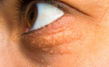 STAVILA SAM OVU NAMIRNICU NA MASNO TKIVO KOD OKA, ono je preko noći nestalo: EVO ŠTA ME SPASILO, SVI GA IMATE U KUĆI