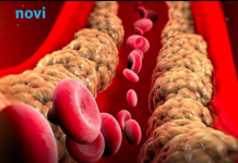 Holesterol ne skače od mesa, već od ove 2 stvari koje su smrt za jetru i samo gomilaju masnoću