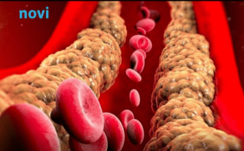 Holesterol ne skače od mesa, već od ove 2 stvari koje su smrt za jetru i samo gomilaju masnoću