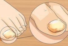 SINOC SAM NAMAZALA OVU SMJESU NA GLJIVICE NA NOKTIMA: One su nestale kao rukom odnesene, GENIJALAN RECEPT MI SPASIO ZIVOT