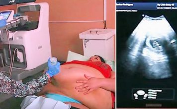 Trudna žena ima 226 kilograma i došla je na ultrazvuk, a onda je medicinska sestra podigla njen stomak i pogledala bolje… (VIDEO)