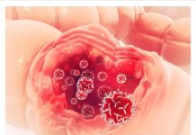 Ovo je prvi simptom RAKA CRIJEVA: Nisu hemeroidi, ako ovo primijetite, ODMAH IDITE DOKTORU – ne sramite se