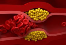 Holesterol ne nastaje zbog slanine i jaja, već zbog ove 2 stvari: Ovo razara jetru i gomila masnoću