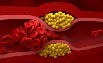 Holesterol ne nastaje zbog slanine i jaja, već zbog ove 2 stvari: Ovo razara jetru i gomila masnoću