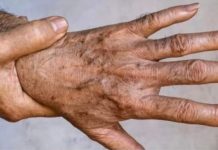 Najvažniji MINERAL Za TRAJNO UKLANJANJE STARAČKIH MRLJA!