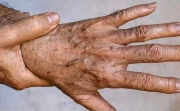 Najvažniji MINERAL Za TRAJNO UKLANJANJE STARAČKIH MRLJA!