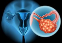 4 RANA SIMPTOMA RAKA JAJNIKA: Svaka žena ovo treba znati, JEDAN SIMPTOM NIKAKO NE SMIJETE IGNORISATI