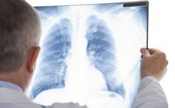 9 SIMPTOMA RAKA PLUĆA NA KOJE TRABATE ODMAH REAGOVATI: Ovako vas tijelo upozorava na ovu bolest!