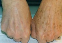 PRIMJETILI STE DA VAM SE POJAVLJUJU STARAČKE PJEGE : To je znak da imate ozbiljan problem sa jednim organom!