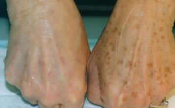 PRIMJETILI STE DA VAM SE POJAVLJUJU STARAČKE PJEGE : To je znak da imate ozbiljan problem sa jednim organom!