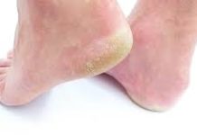 Jeftino čudo iz kuhinje koje spašava vaša stopala: RlJEŠlTE SE ZAUVlJEK ISPUCALlH PETA, GLJlVlCA I KURJlH 0ČlJU….