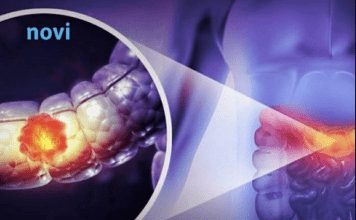 Čak 91 % veći rizik od raka debelog crijeva: Ova navika može vas skupo stajati!