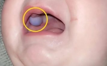 Majka je primetila nešto neobično u ustima svog devetomesečnog sina i odmah je otišla kod lekara — otkriće lekara bilo je iznenađujuće.