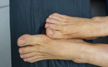 Visok holesterol možete prepoznati ako se zagledate u svoje noge: Ako primijetite ovo – imate ozbiljan problem