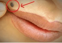 OTKRIJTE ISTINU Šta znači ako imate mladež na licu, ruci ili stopalu