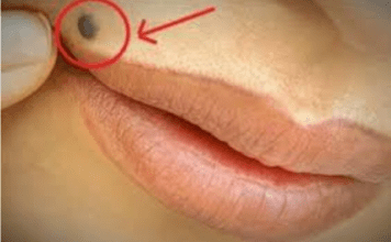 OTKRIJTE ISTINU Šta znači ako imate mladež na licu, ruci ili stopalu