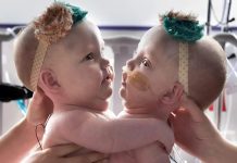 Ove povezane sestre su rođene spojene na grudima i stomaku 😱 Zbog ove povezanosti, imale su poteškoće da sede, okrenu se ili čak leže udobno 😢