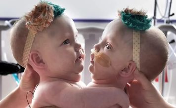 Ove povezane sestre su rođene spojene na grudima i stomaku 😱 Zbog ove povezanosti, imale su poteškoće da sede, okrenu se ili čak leže udobno 😢