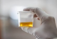 OSJETlTE Ll JAK MlRlS URlNA? To nije infekcija urinarnog trakta, već mnogo opasnije stanje koje IMATE…