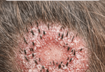 Zabrinuta Sam Zbog Crvenog Prstena i Lomljenja Kose: Dijagnoza Koja Me Iznenadila