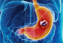 5 ranih simptoma raka želuca: Tumor može da raste godinama, a svi pacijenti prvo osjete ovo